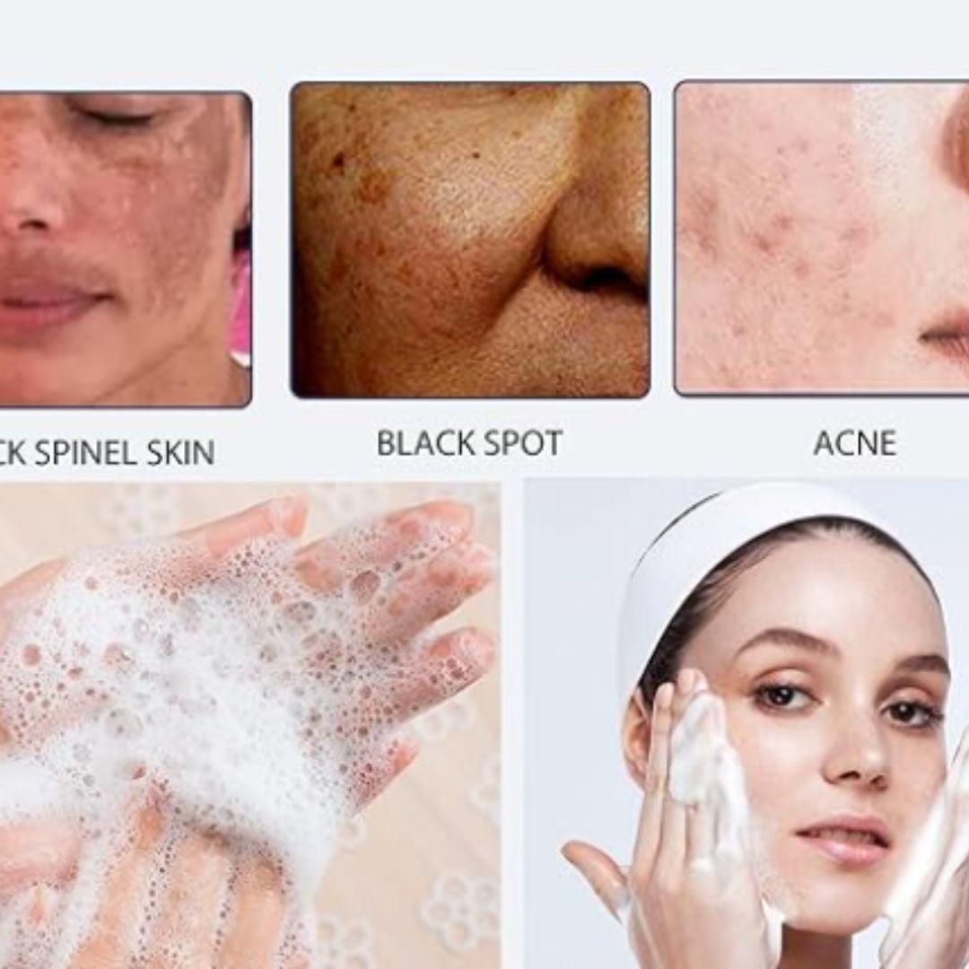 लुकाची फॉर एक्ने स्पॉट क्लींजिंग लोशन 50 एमएल (2 का पैक)